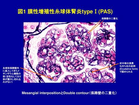 図1 膜性増殖性糸球体腎炎typeⅠ(PAS)