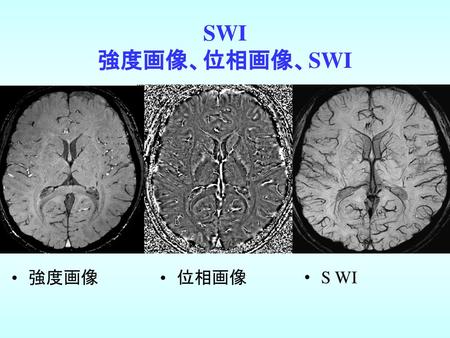 SWI 強度画像、位相画像、SWI 強度画像 位相画像 S WI.