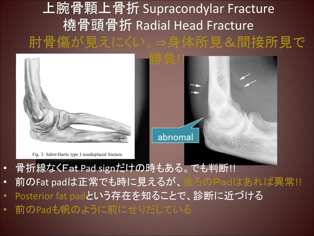 上腕骨顆上骨折 Supracondylar Fracture 橈骨頭骨折 Radial Head Fracture