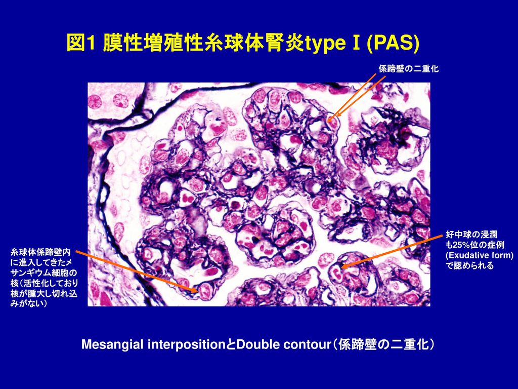 図1 膜性増殖性糸球体腎炎type Pas Ppt Download