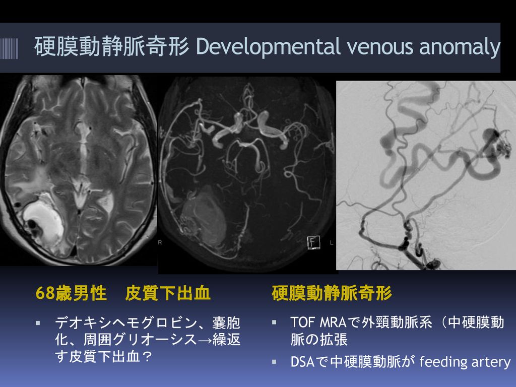 硬膜動静脈奇形 Developmental Venous Anomaly Ppt Download