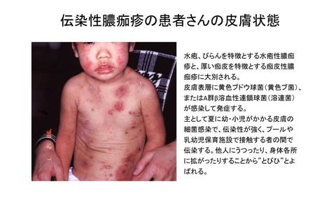 伝染性膿痂疹の患者さんの皮膚状態 水疱、びらんを特徴とする水疱性膿痂疹と、厚い痂皮を特徴とする痂皮性膿痂疹に大別される。