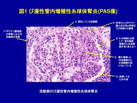 図1 び漫性管内増殖性糸球体腎炎(PAS像)