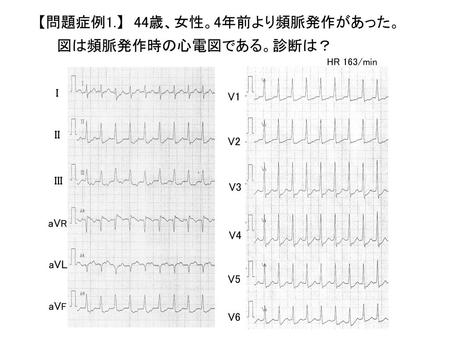 【問題症例1.】 44歳、女性。4年前より頻脈発作があった。図は頻脈発作時の心電図である。診断は？