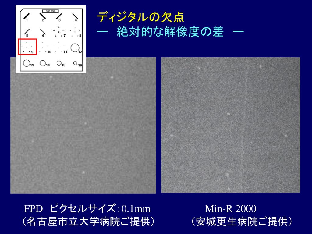 ディジタルの欠点 ー 絶対的な解像度の差 ー FPD ピクセルサイズ：0.1mm Min-R 2000 （名古屋市立大学病院ご提供）