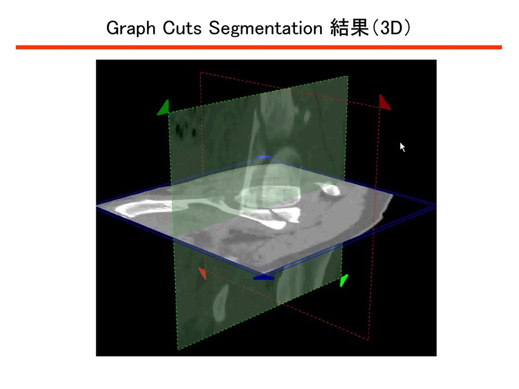 Graph Cuts Segmentation 結果（3D）