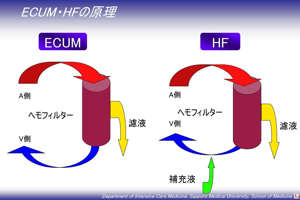 ECUM・HFの原理 ECUM HF V側 ヘモフィルター 濾液 A側 V側 ヘモフィルター 濾液 補充液 A側