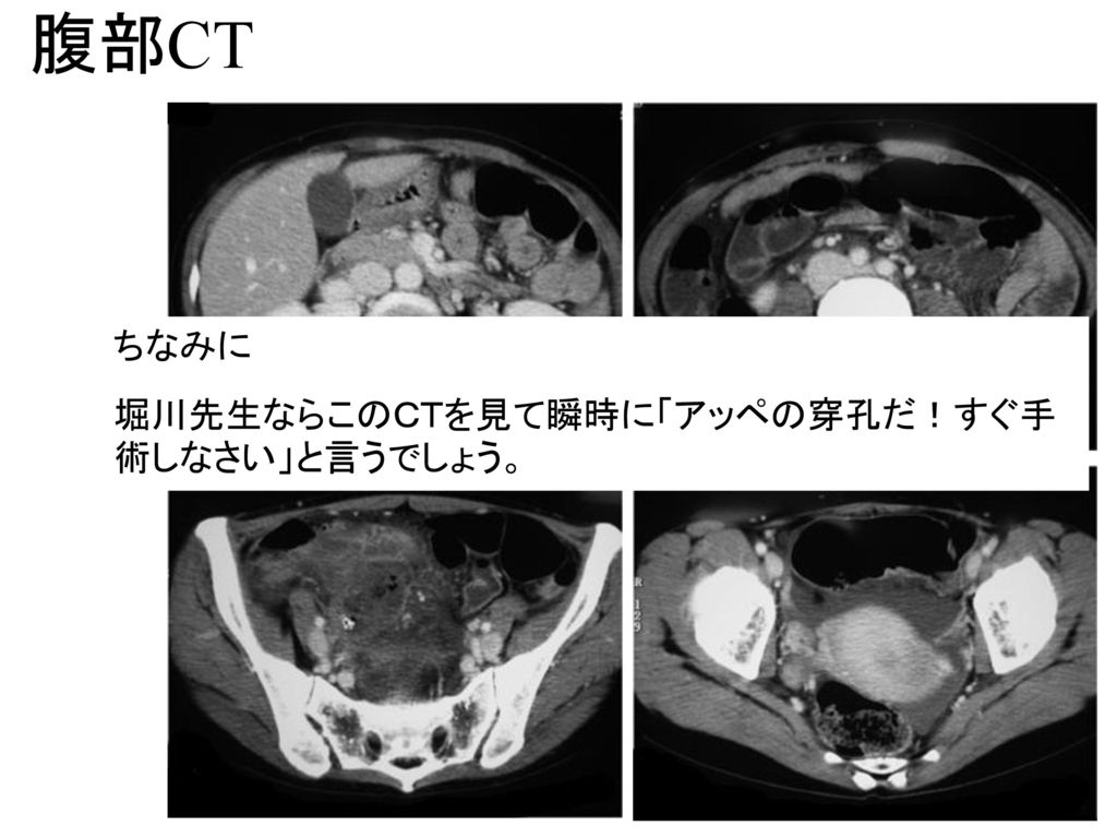 腹部CT ちなみに 堀川先生ならこのＣＴを見て瞬時に「アッペの穿孔だ！すぐ手術しなさい」と言うでしょう。