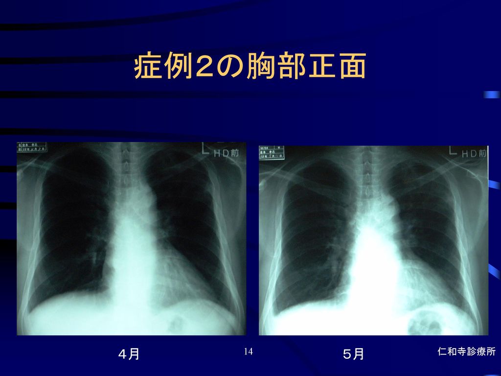 症例２の胸部正面 ４月 ５月 仁和寺診療所