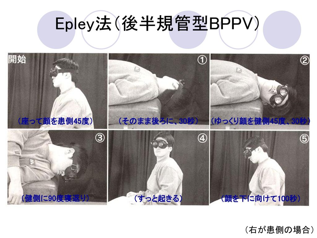 Epley法（後半規管型BPPV） （右が患側の場合） （座って顔を患側45度） （そのまま後ろに、30秒）