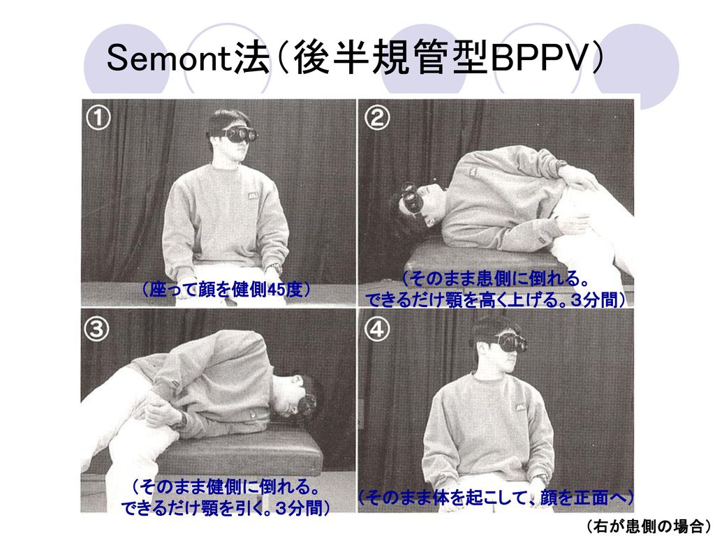 Semont法（後半規管型BPPV） （そのまま患側に倒れる。 できるだけ顎を高く上げる。３分間） （座って顔を健側45度）