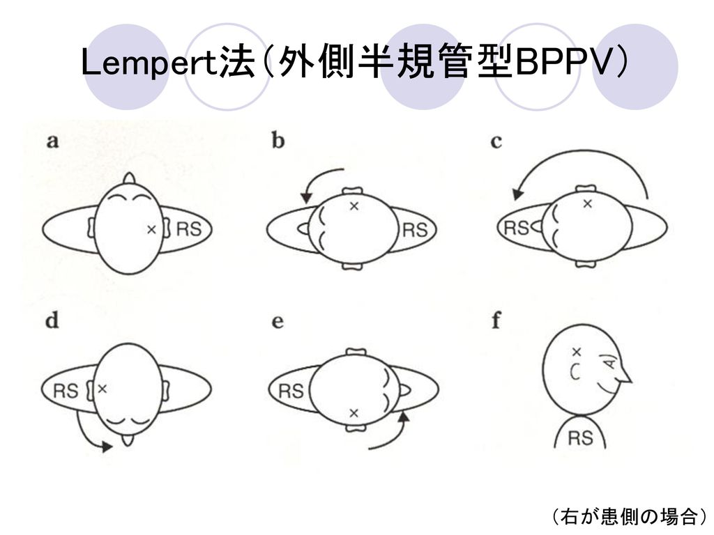 Lempert法（外側半規管型BPPV）