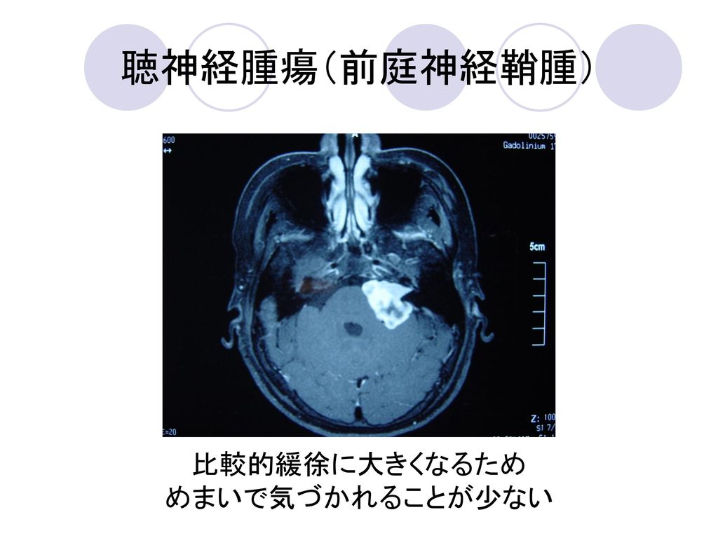 聴神経腫瘍（前庭神経鞘腫） 比較的緩徐に大きくなるため めまいで気づかれることが少ない