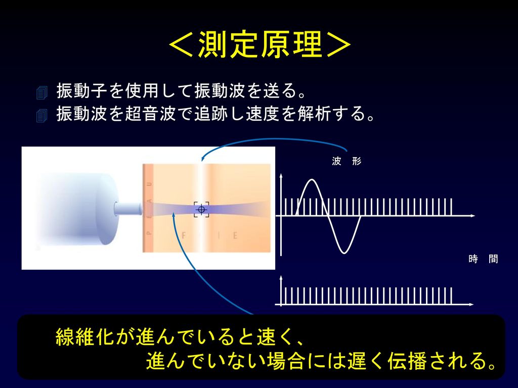 ＜測定原理＞ 線維化が進んでいると速く､ 進んでいない場合には遅く伝播される｡ 振動子を使用して振動波を送る。