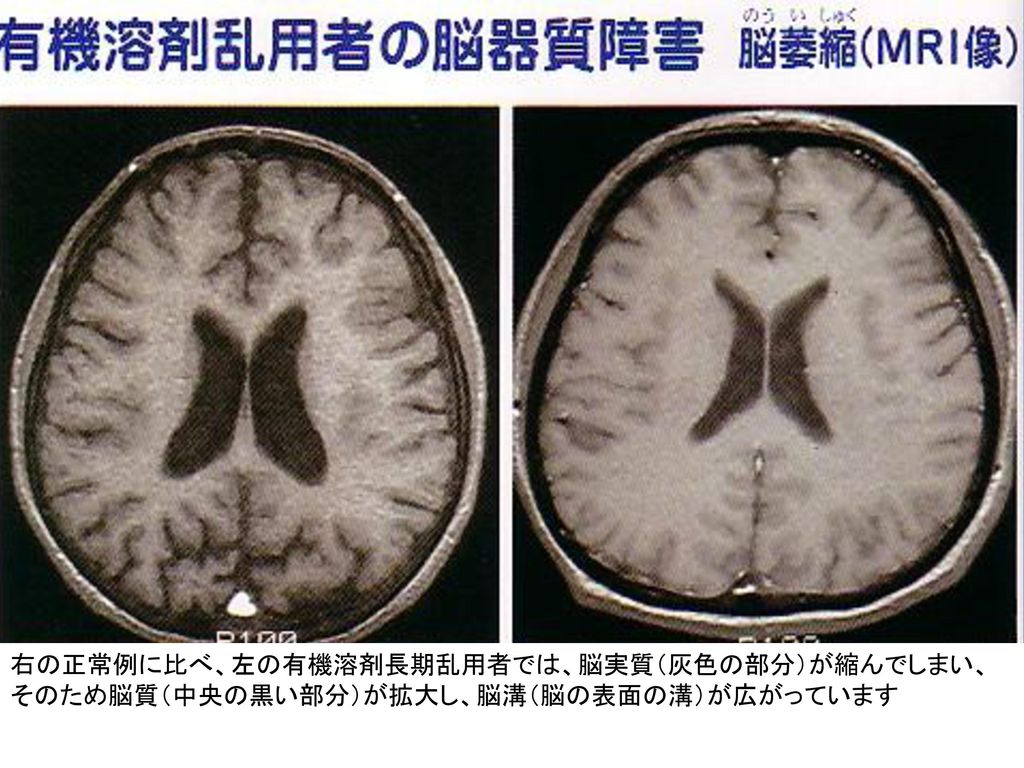 右の正常例に比べ、左の有機溶剤長期乱用者では、脳実質（灰色の部分）が縮んでしまい、