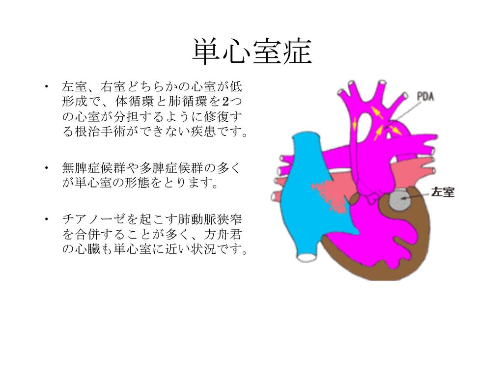 単心室症 左室、右室どちらかの心室が低形成で、体循環と肺循環を2つの心室が分担するように修復する根治手術ができない疾患です。