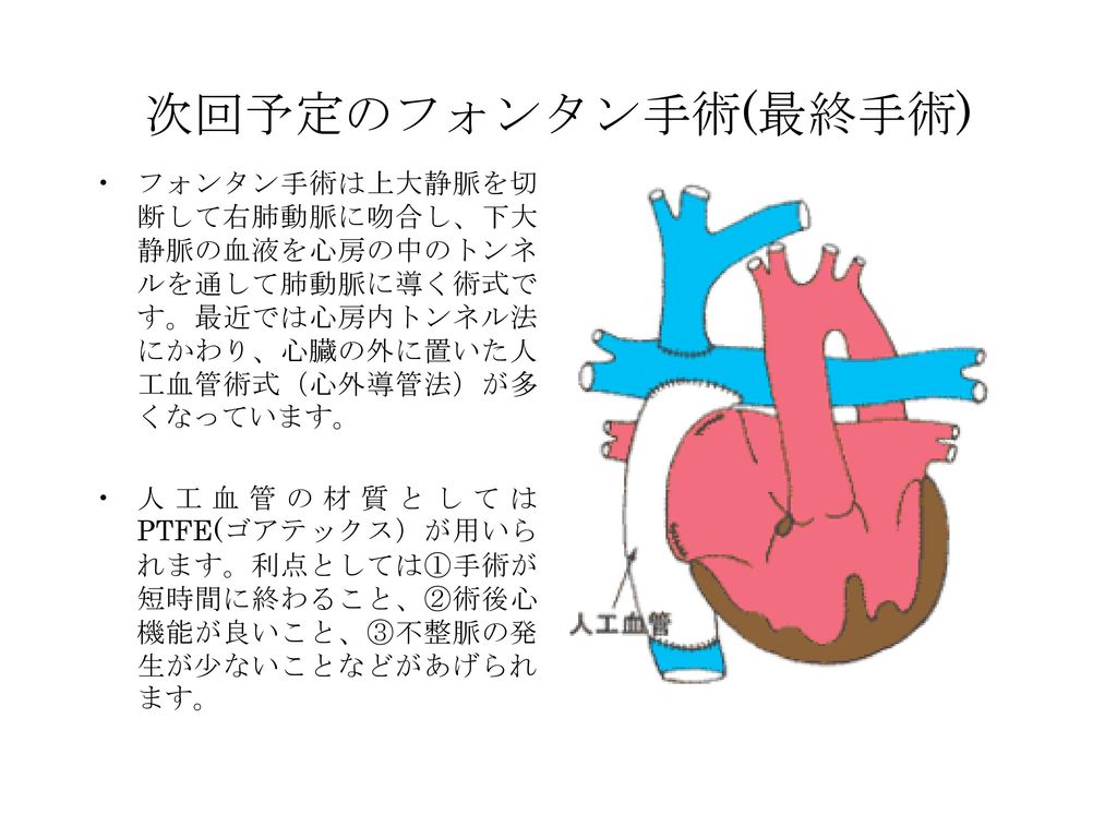 次回予定のフォンタン手術(最終手術) フォンタン手術は上大静脈を切断して右肺動脈に吻合し、下大静脈の血液を心房の中のトンネルを通して肺動脈に導く術式です。最近では心房内トンネル法にかわり、心臓の外に置いた人工血管術式（心外導管法）が多くなっています。