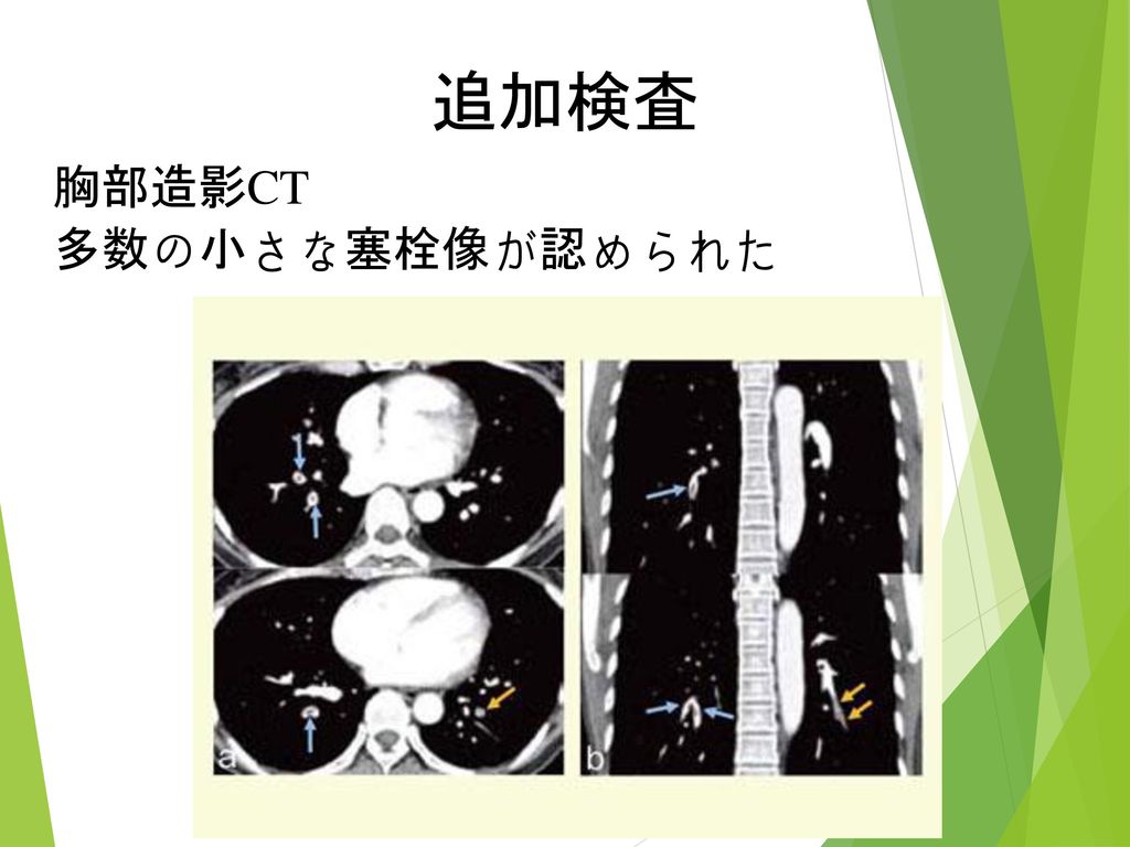 追加検査 胸部造影CT 多数の小さな塞栓像が認められた