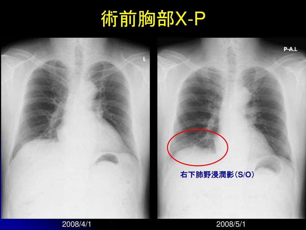 術前胸部X-P 右下肺野浸潤影（S/O） 2008/4/1 2008/5/1