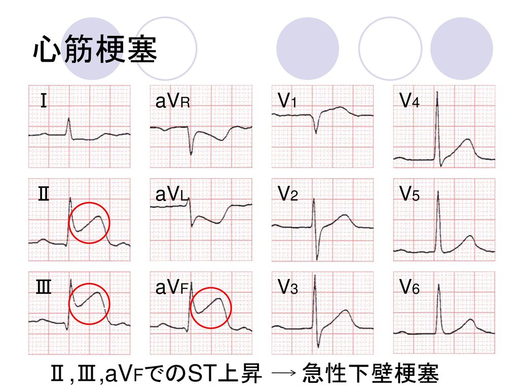 心筋梗塞 Ⅰ aVR V1 V4 Ⅱ aVL V2 V5 Ⅲ aVF V3 V6 Ⅱ,Ⅲ,aVFでのST上昇 急性下壁梗塞