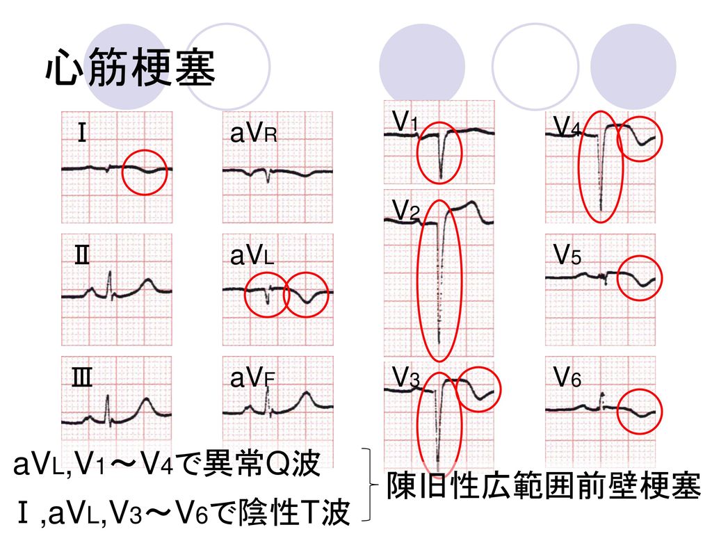 心筋梗塞 aVL,V1～V4で異常Q波 陳旧性広範囲前壁梗塞 Ⅰ,aVL,V3～V6で陰性T波 V1 V4 Ⅰ aVR V2 Ⅱ aVL