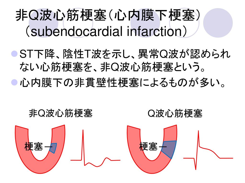 非Q波心筋梗塞（心内膜下梗塞） （subendocardial infarction）