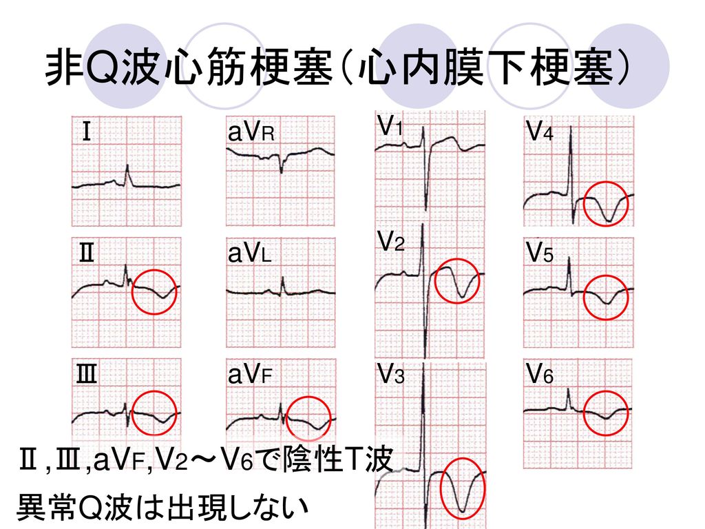 非Q波心筋梗塞（心内膜下梗塞） Ⅱ,Ⅲ,aVF,V2～V6で陰性T波 異常Q波は出現しない V1 Ⅰ aVR V4 V2 Ⅱ aVL V5
