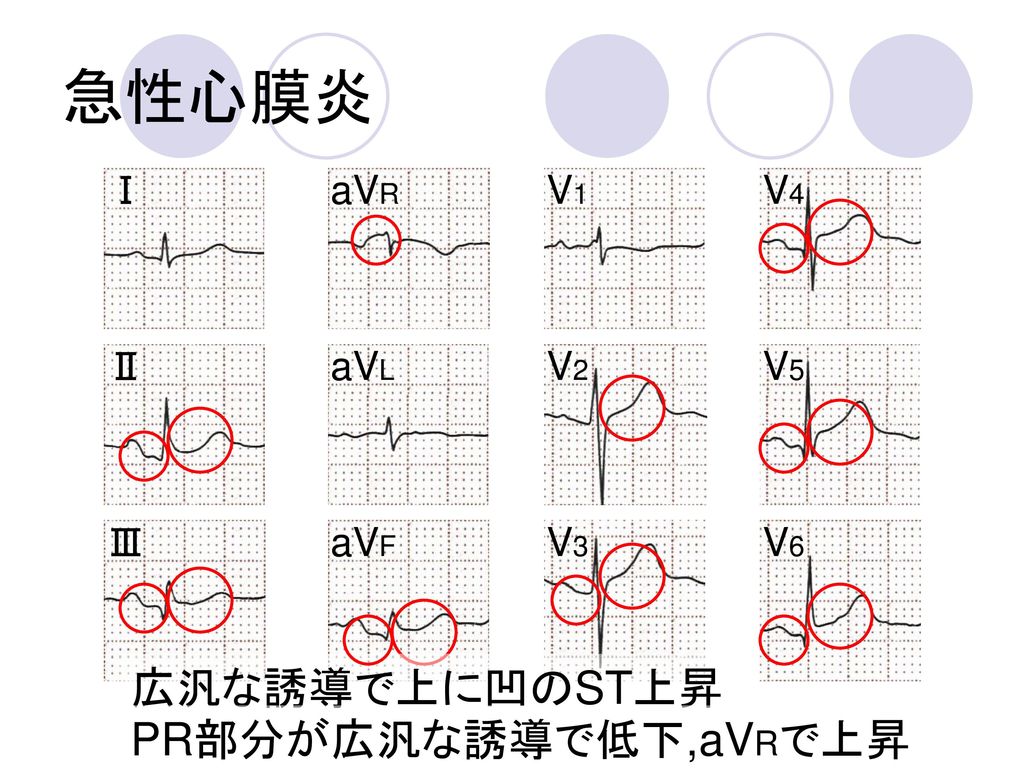 急性心膜炎 広汎な誘導で上に凹のST上昇 PR部分が広汎な誘導で低下,aVRで上昇 Ⅰ aVR V1 V4 Ⅱ aVL V2 V5 Ⅲ