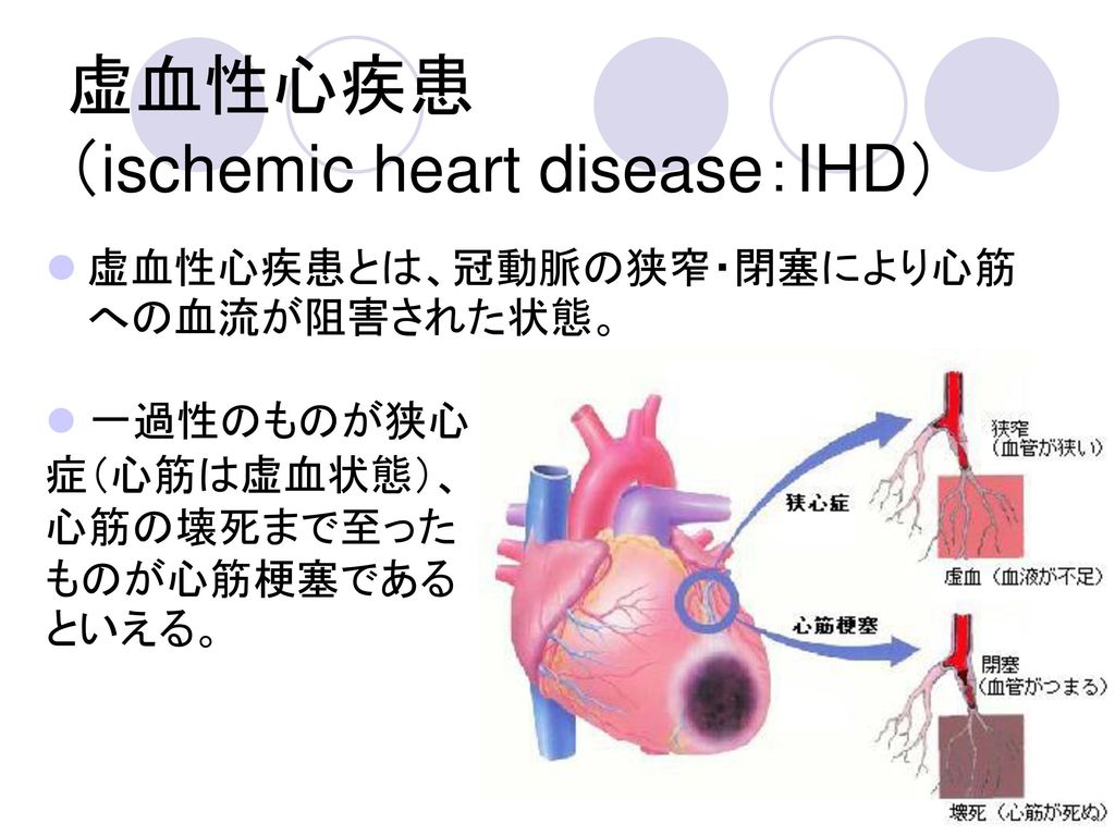 虚血性心疾患 （ischemic heart disease：IHD）