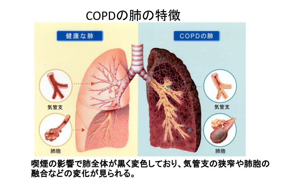 超可爱 Copdシャツ トレーナー 慢性障害物肺疾患啓発 その他サッカーウエア Www Woodland Living Com