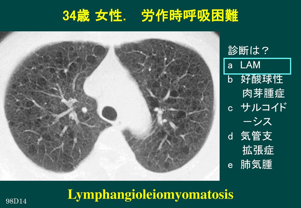 Lymphangioleiomyomatosis