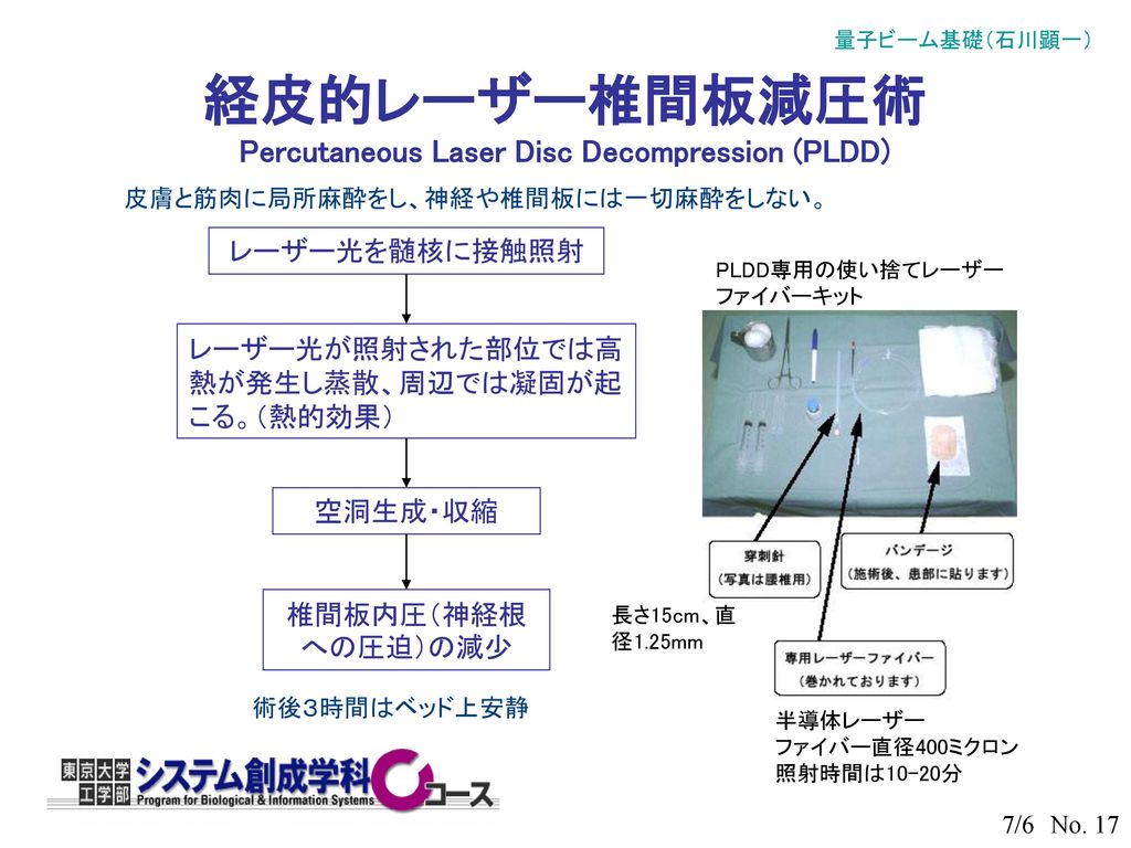経皮的レーザー椎間板減圧術 Percutaneous Laser Disc Decompression (PLDD)