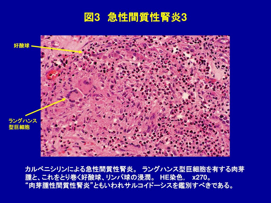 図3 急性間質性腎炎3 カルベニシリンによる急性間質性腎炎。 ラングハンス型巨細胞を有する肉芽
