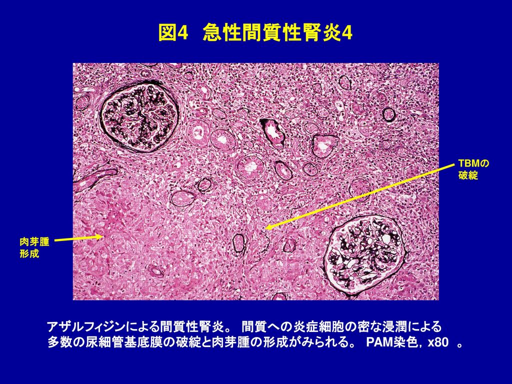 図4 急性間質性腎炎4 アザルフィジンによる間質性腎炎。 間質への炎症細胞の密な浸潤による