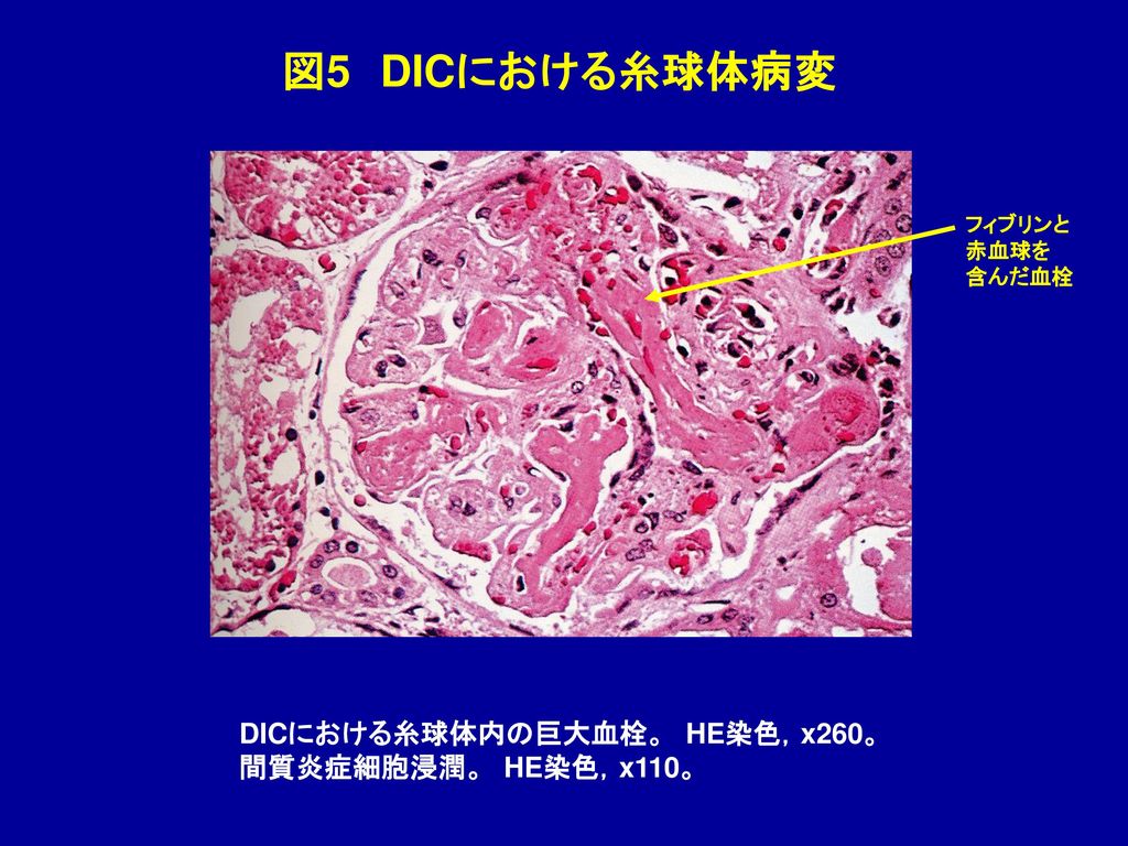 図5 DICにおける糸球体病変 DICにおける糸球体内の巨大血栓。 HE染色，x260。 間質炎症細胞浸潤。 HE染色，x110。