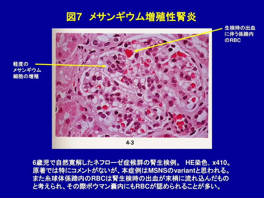 図7 メサンギウム増殖性腎炎 6歳児で自然寛解したネフローゼ症候群の腎生検例。 HE染色，x410。