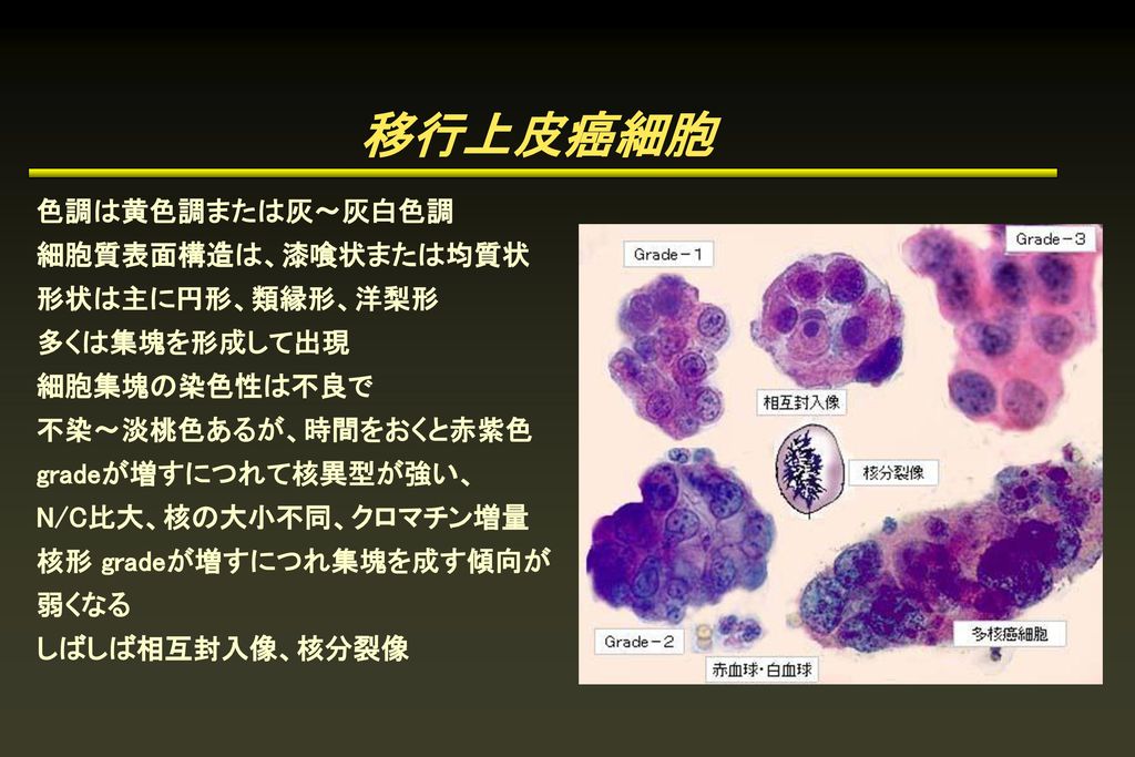 移行上皮癌細胞 色調は黄色調または灰〜灰白色調 細胞質表面構造は、漆喰状または均質状 形状は主に円形、類縁形、洋梨形
