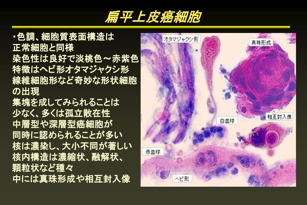 扁平上皮癌細胞 ・色調、細胞質表面構造は 正常細胞と同様 染色性は良好で淡桃色〜赤紫色 特徴はヘビ形オタマジャクシ形