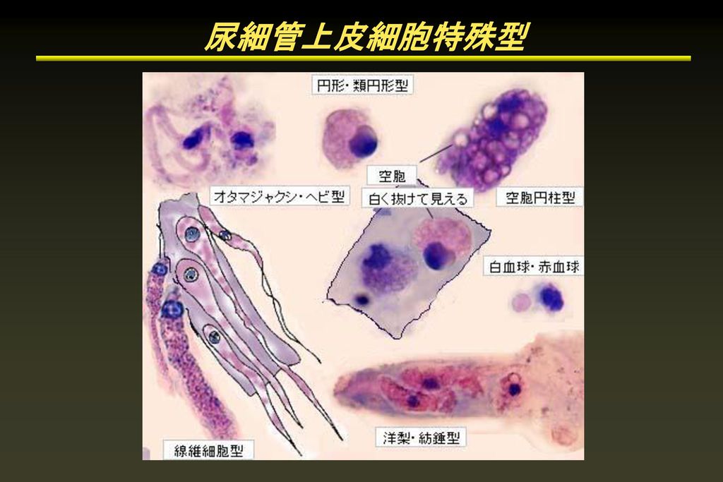 尿細管上皮細胞特殊型