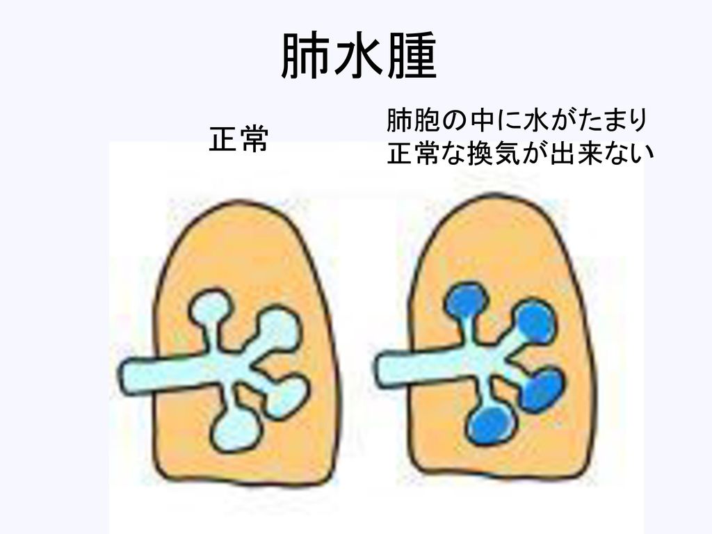 肺水腫 肺胞の中に水がたまり 正常な換気が出来ない 正常