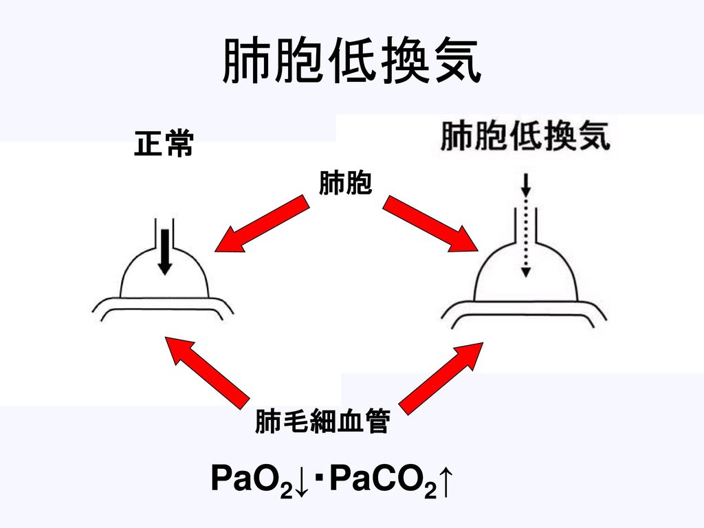 肺胞低換気 肺毛細血管 肺胞 正常 PaO2↓・PaCO2↑