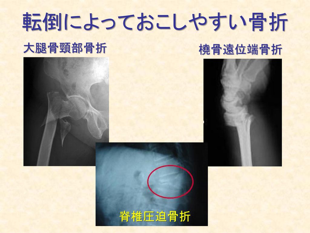 転倒によっておこしやすい骨折 大腿骨頸部骨折 橈骨遠位端骨折 脊椎圧迫骨折