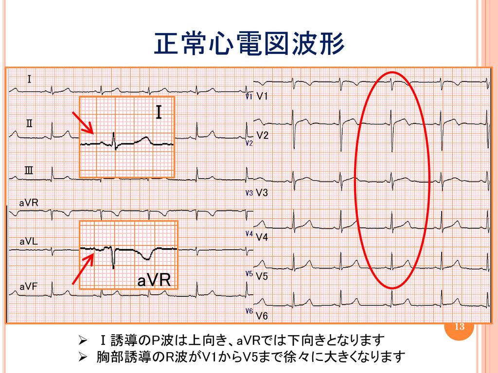 正常心電図波形 Ⅰ aVR Ⅰ誘導のP波は上向き、aVRでは下向きとなります 胸部誘導のR波がV1からV5まで徐々に大きくなります Ⅰ V1