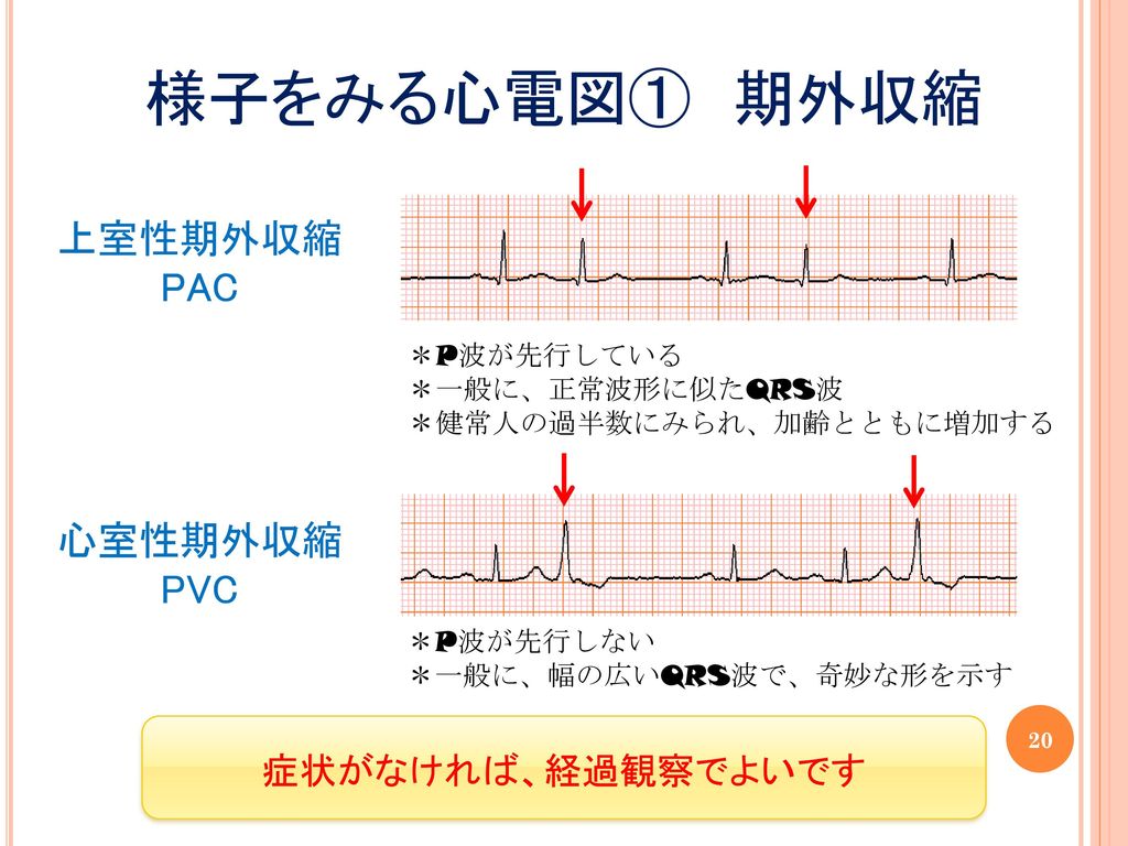 様子をみる心電図① 期外収縮 上室性期外収縮 PAC 心室性期外収縮 PVC 症状がなければ、経過観察でよいです ＊P波が先行している