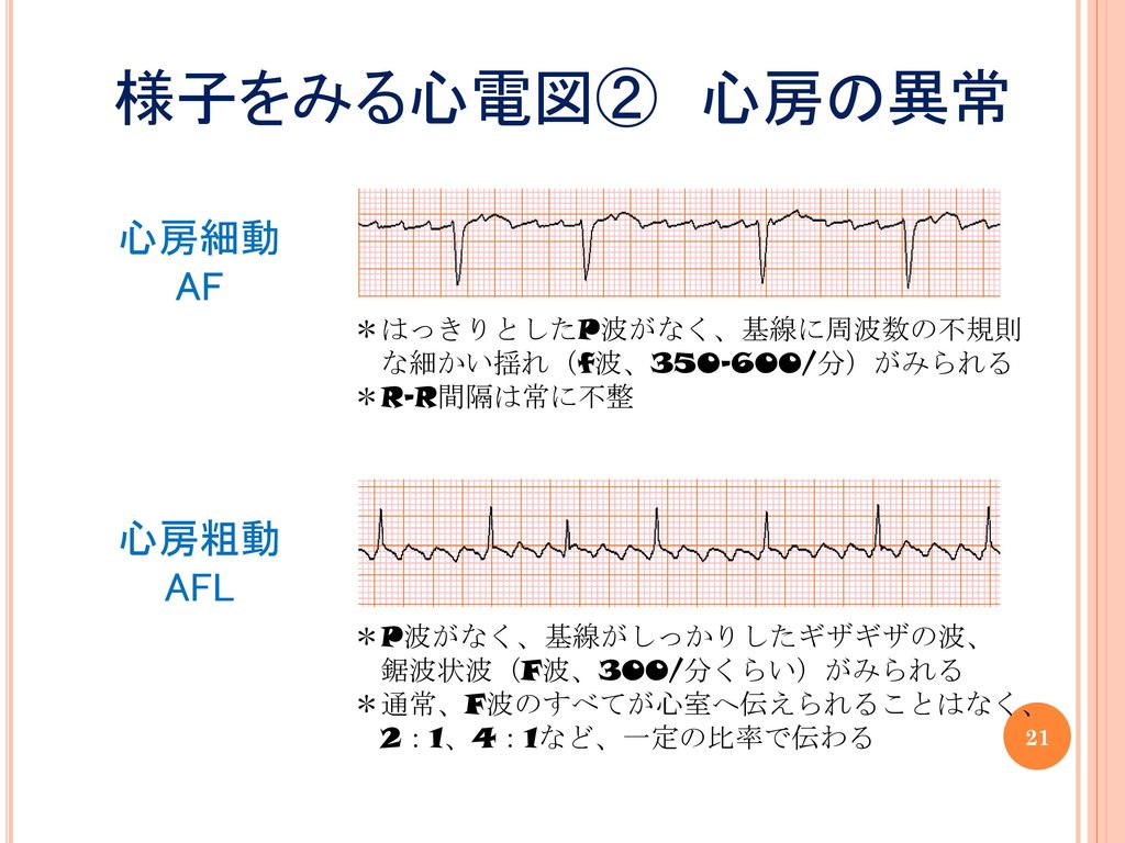 様子をみる心電図② 心房の異常 心房細動 AF 心房粗動 AFL ＊はっきりとしたP波がなく、基線に周波数の不規則