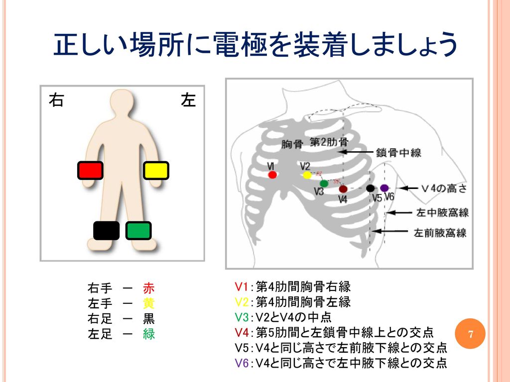 正しい場所に電極を装着しましょう 右 左 右手 － 赤 V1：第4肋間胸骨右縁 左手 － 黄 V2：第4肋間胸骨左縁 右足 － 黒