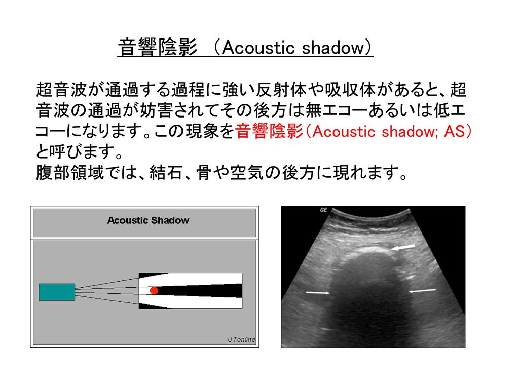 音響陰影 （Acoustic shadow）