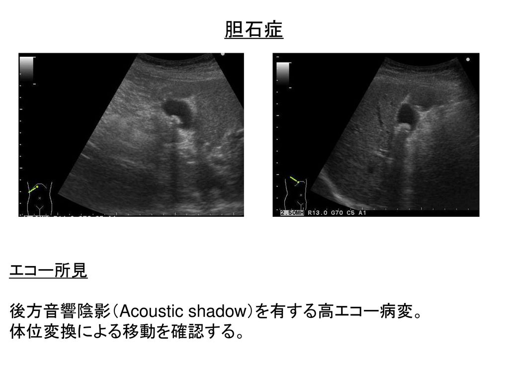 胆石症 エコー所見 後方音響陰影（Acoustic shadow）を有する高エコー病変。 体位変換による移動を確認する。
