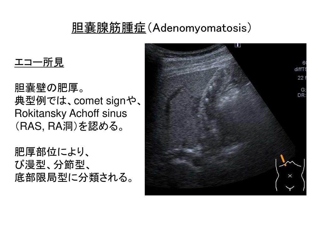 胆嚢腺筋腫症（Adenomyomatosis）