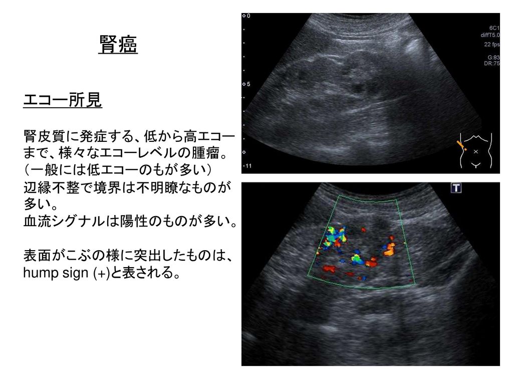 嚢胞 エコー 腎 膵臓、脾臓、腎臓のエコー（超音波）画像の見方・疾患とその所見
